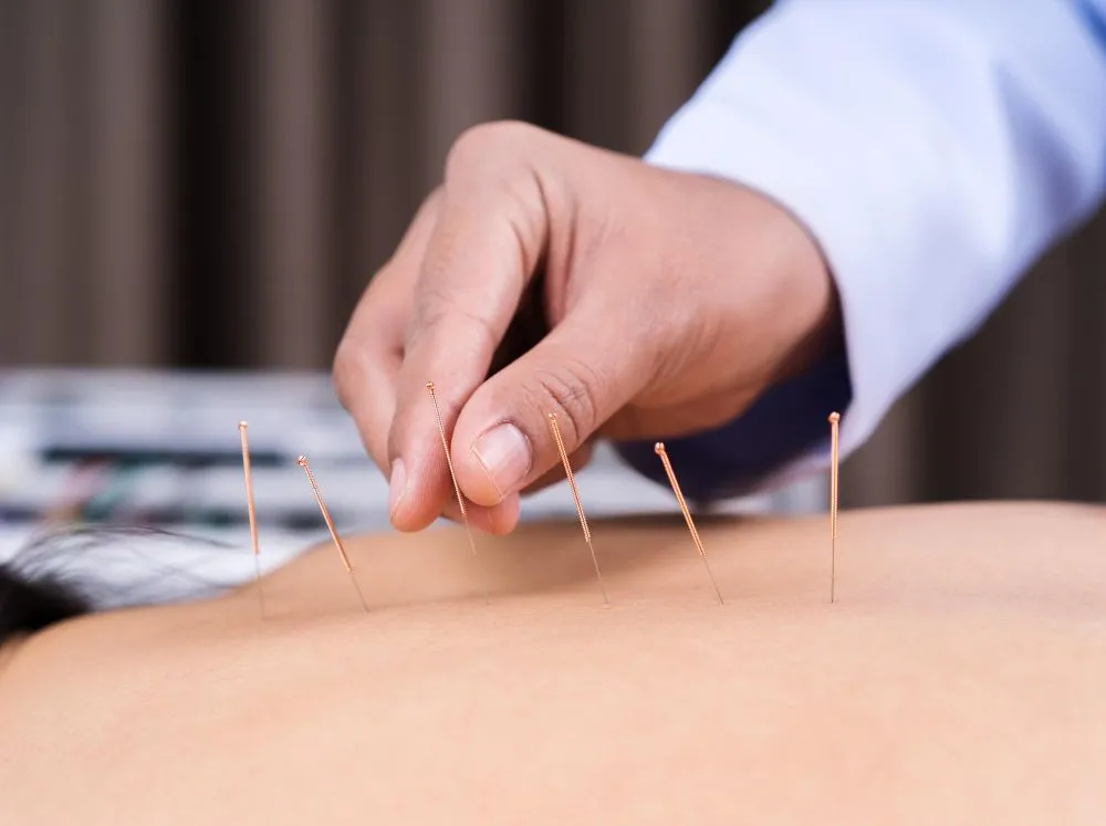 Licensed acupuncturist inserting thin needles into a patient's back during a safe acupuncture treatment session