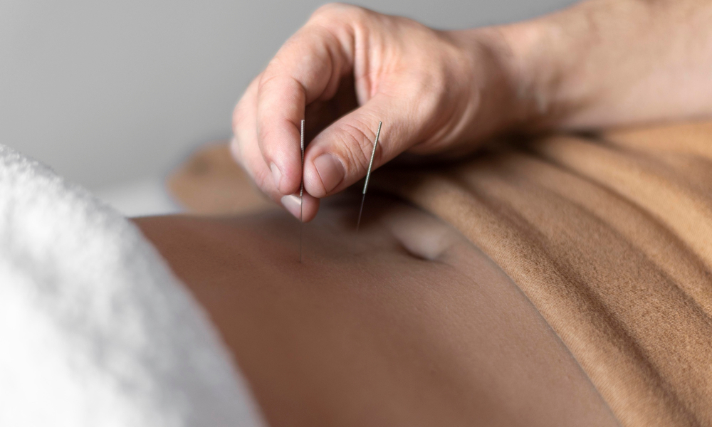 acupuncture